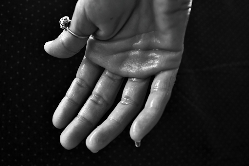 excessive sweating on a hand