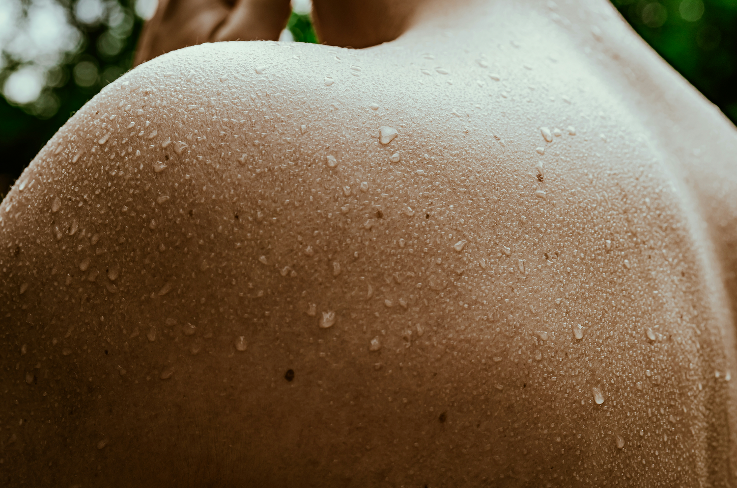 Excessive sweating on the back